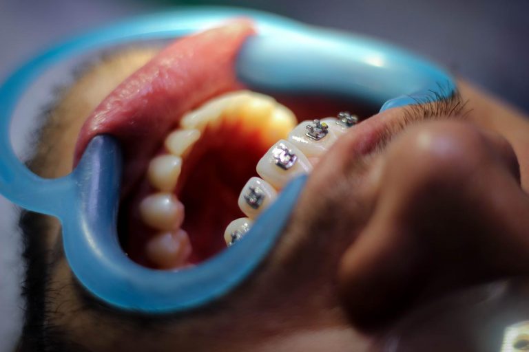 orthodontics-gad6806173_1280